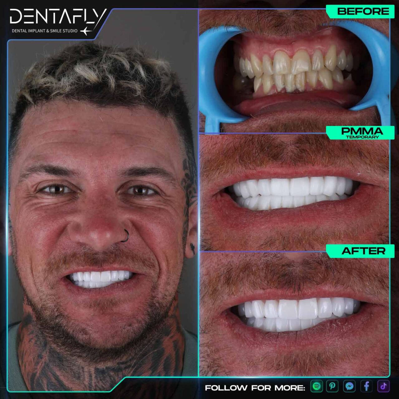 Simon Luke dental implant before and after