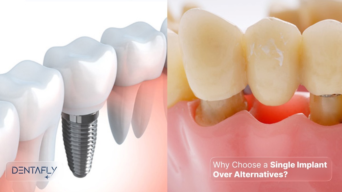 Comparison between single dental implant and traditional bridge alternatives showing why implants preserve bone