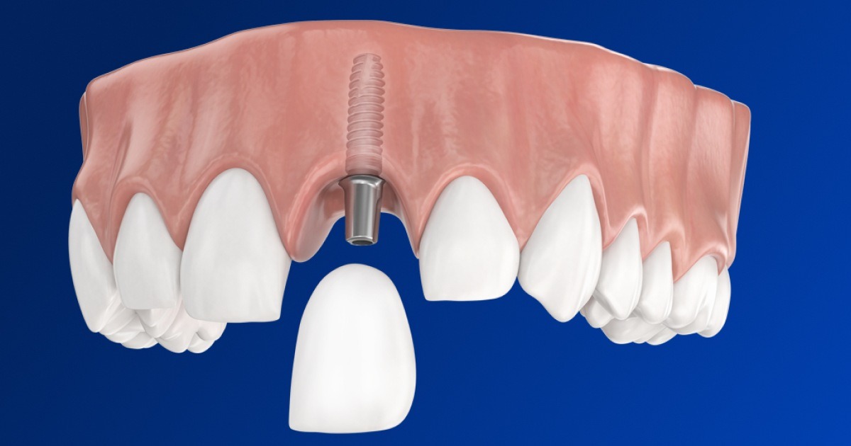 Single tooth implant procedure step-by-step from extraction socket to final crown placement