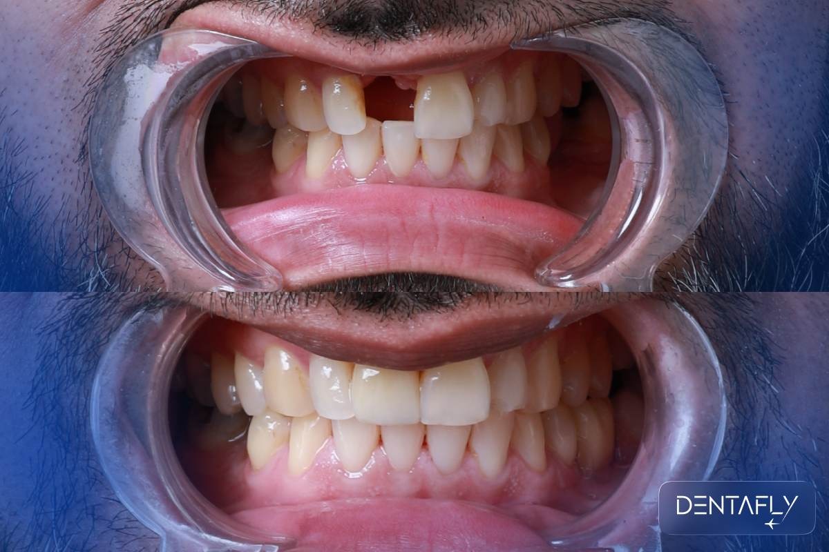 Single tooth implant in Turkey permanent solution for one missing tooth at Dentafly Antalya