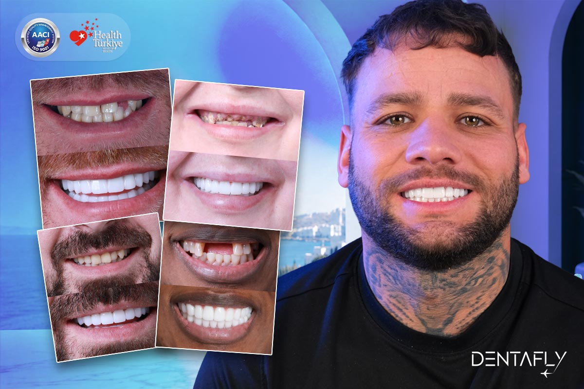 Smile makeover before after grid collage UK patients veneers crowns transformations natural shade Dentafly Antalya 700 cases