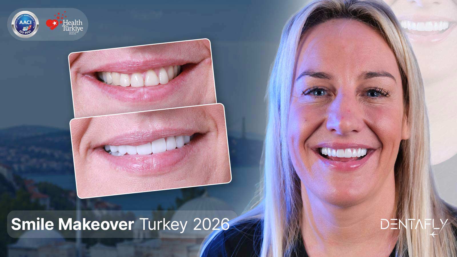 Smile makeover Turkey UK patient before after transformation natural shade veneers crowns Antalya Bosphorus AACI Health Türkiye Dentafly