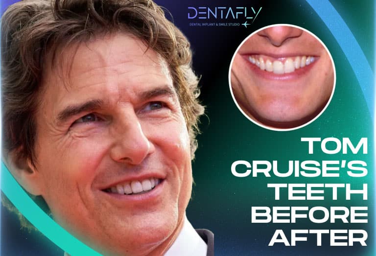 Tom Cruise smile before and after