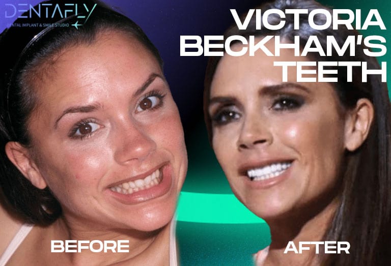 Victoria Beckham Teeth Before and After