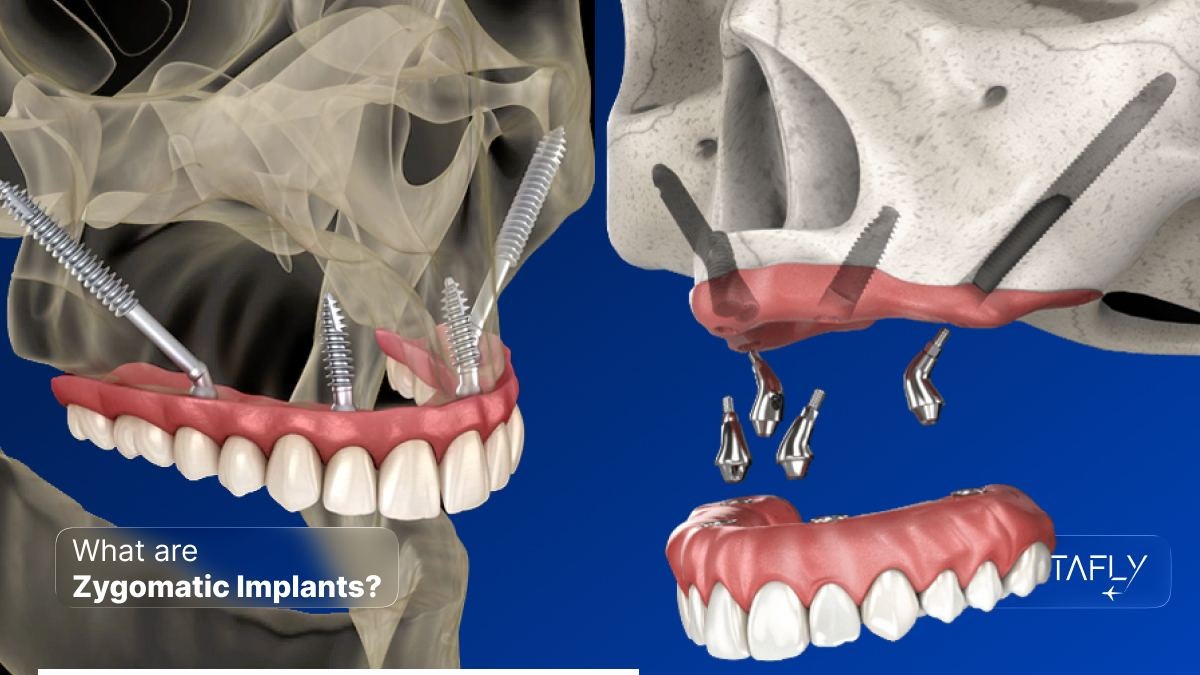 What are zygomatic implants 3D illustration showing cheekbone anchored placement