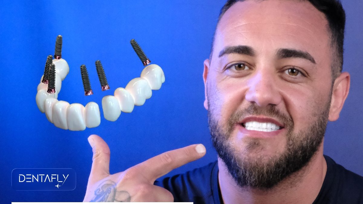 What is 3-on-6 dental implants explanation diagram showing three bridges on six titanium implants per arch full mouth restoration