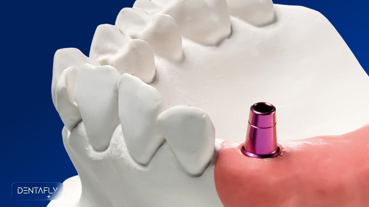 3D anatomical illustration showing what a single tooth implant is with titanium screw abutment and crown