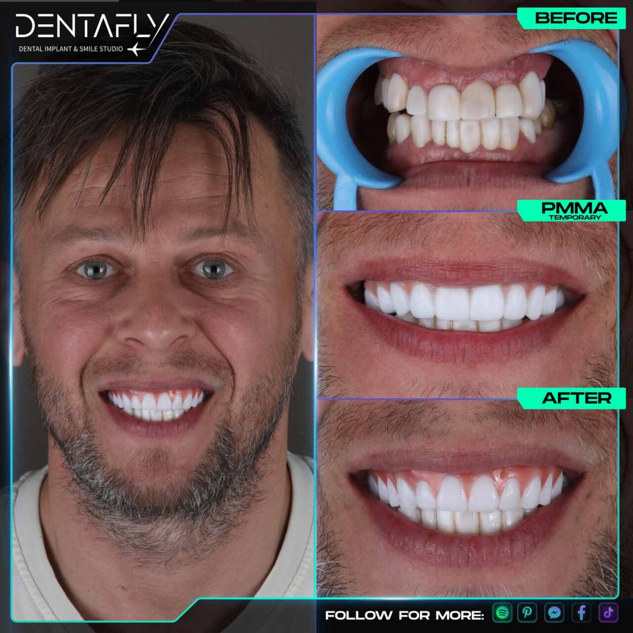 Zsolta smile before and after