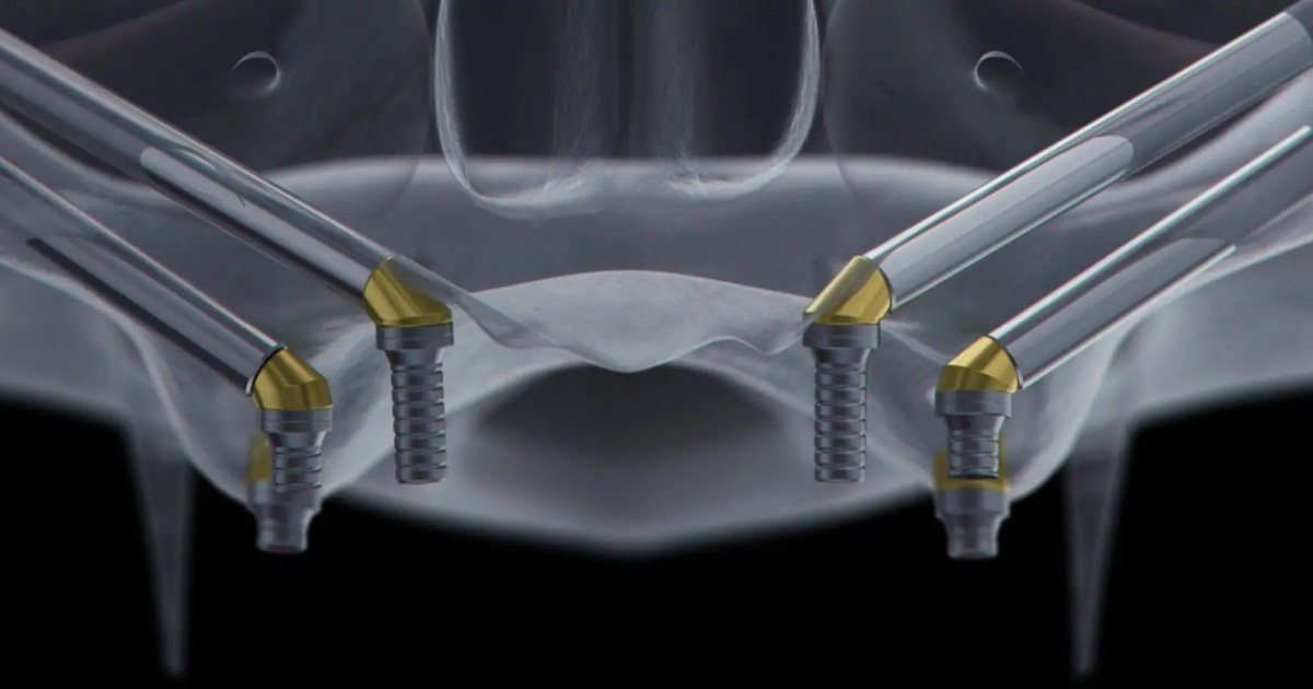 Zygomatic Implants Turkey Zygomatic implants in Turkey for severe bone loss patients at Dentafly Antalya clinic