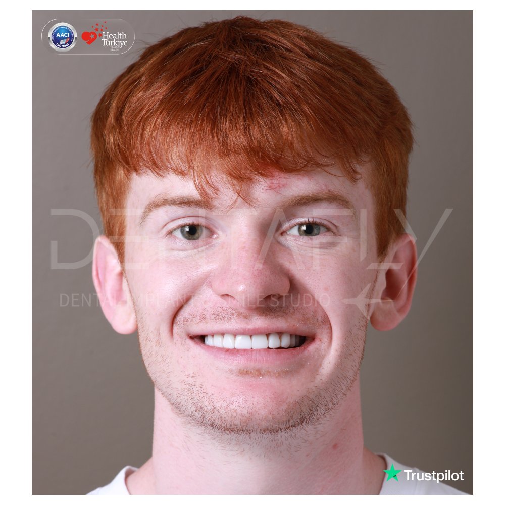 Callum Darran smiling after composite bonding at Dentafly Antalya