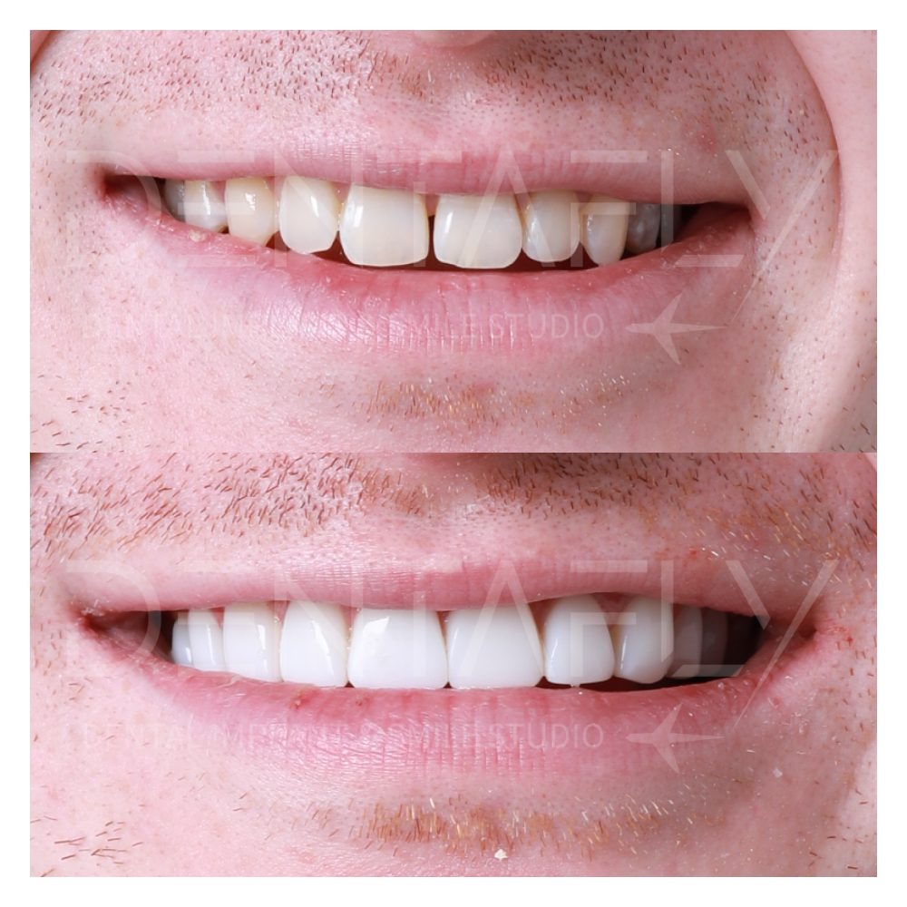 Callum Darran composite bonding before and after, Dentafly Antalya