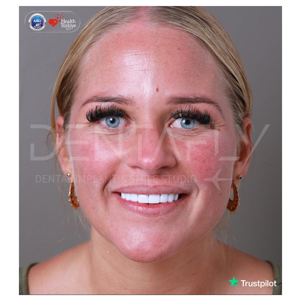 Charlotte Summers smiling after composite bonding at Dentafly Antalya