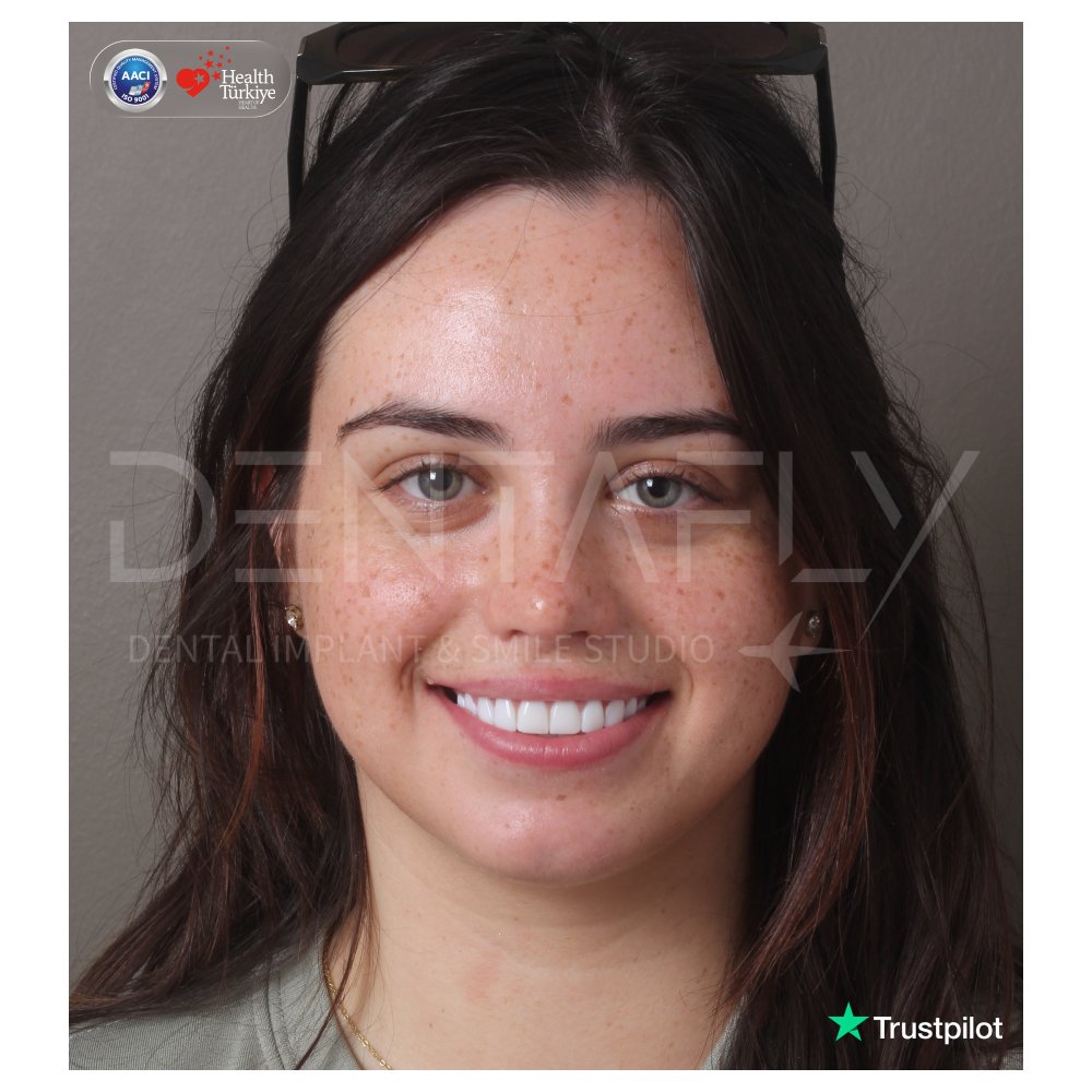 Christina Sarah smiling after composite bonding at Dentafly Antalya
