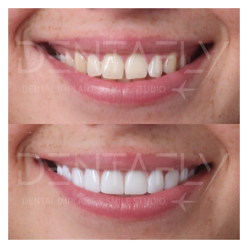 Christina Sarah composite bonding before and after, Dentafly Antalya