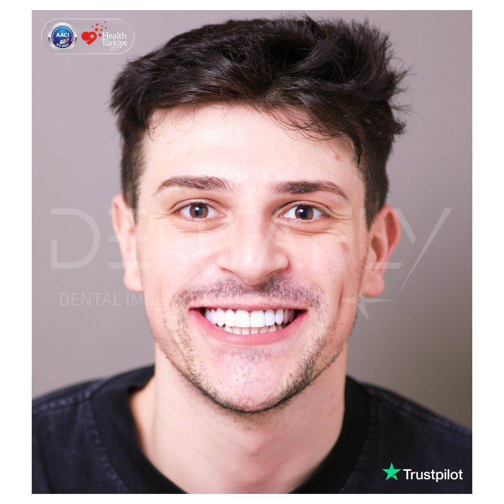 Giovanni Legrottaglie smiling after composite bonding at Dentafly Antalya