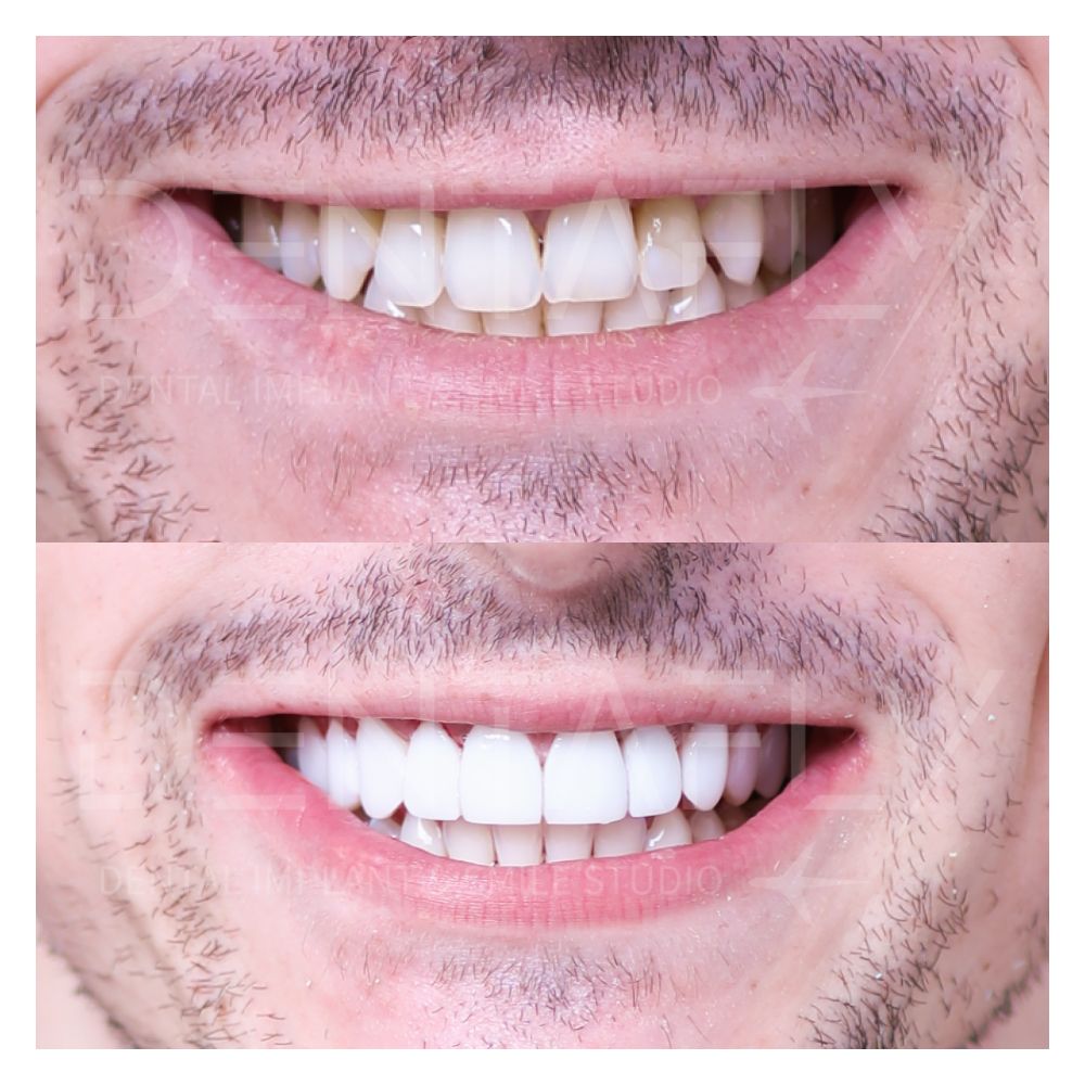 Giovanni Legrottaglie composite bonding before and after, Dentafly Antalya