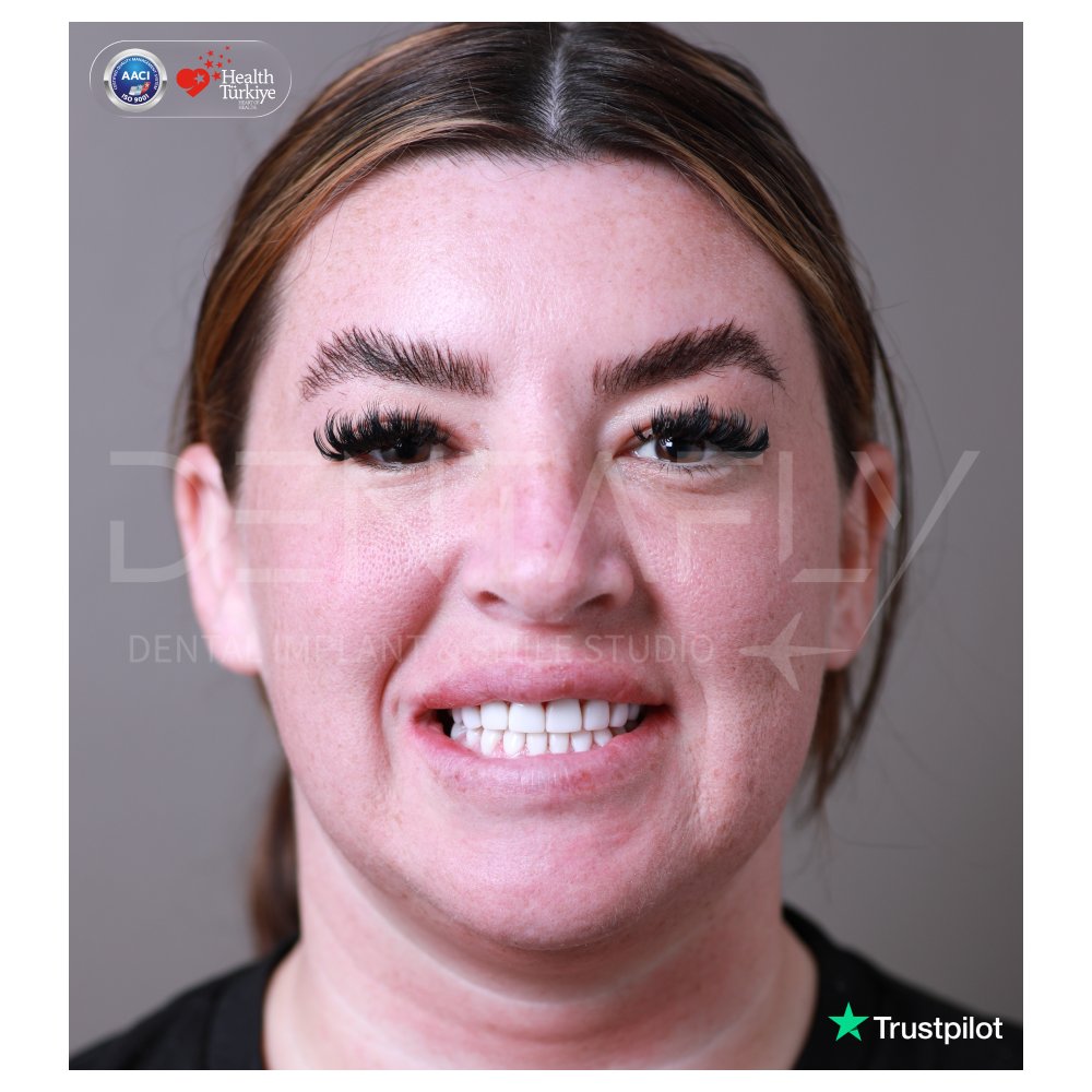 Jemma Louise Maddock smiling after composite bonding at Dentafly Antalya