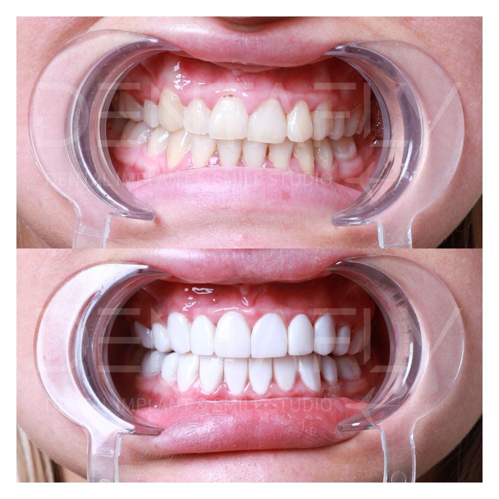 Katie Richardson composite bonding before and after, Dentafly Antalya