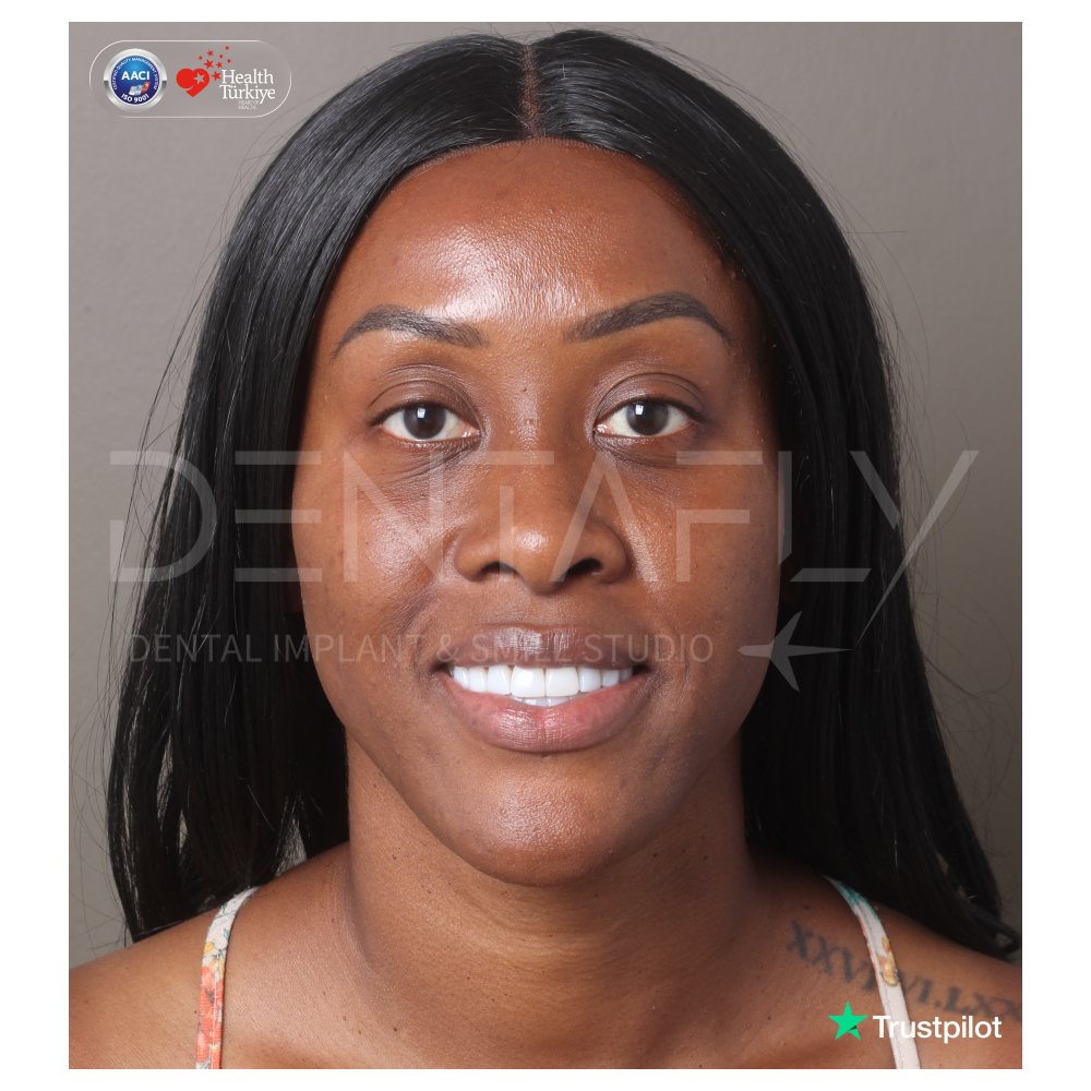 Lattoya Sanica Scott smiling after composite bonding at Dentafly Antalya