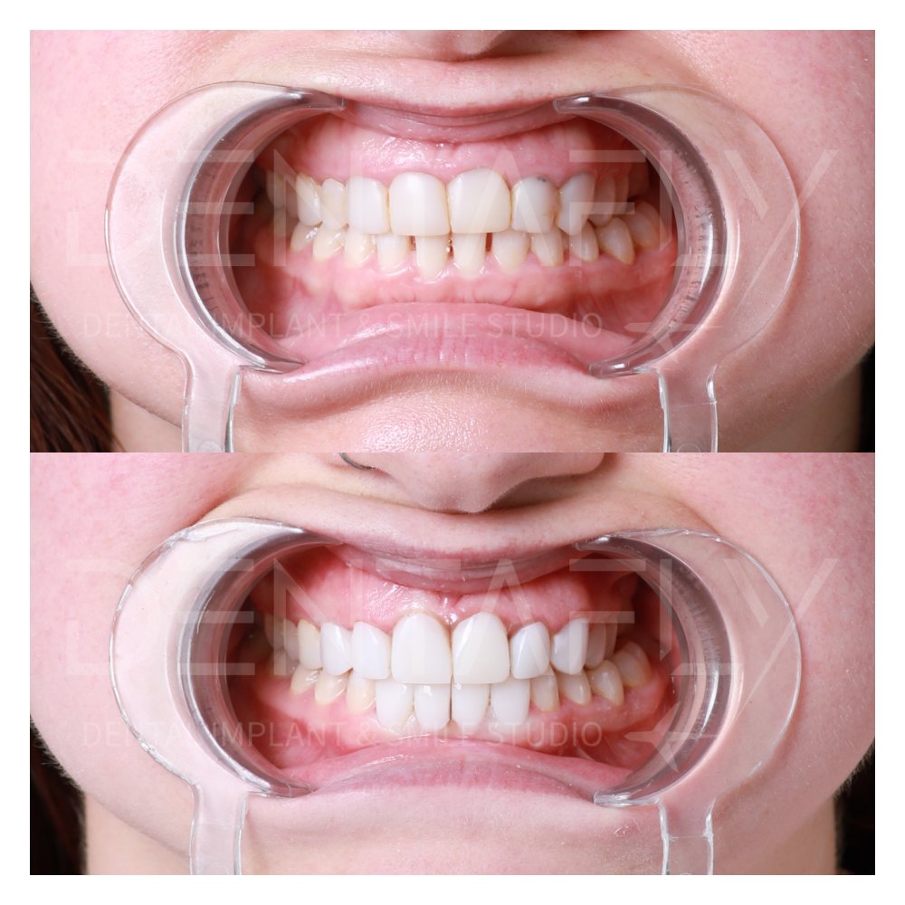 Lauren Ashleigh Ditcham composite bonding before and after, Dentafly Antalya