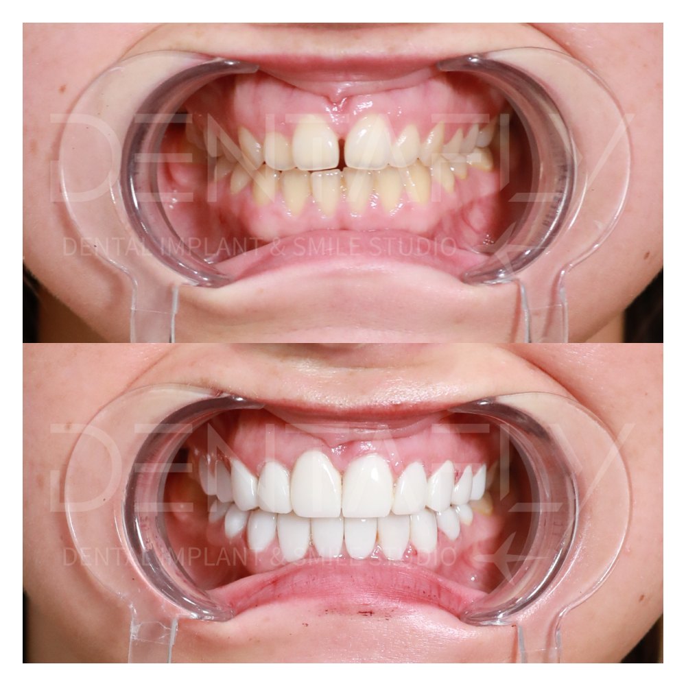 Shannice Innes composite bonding before and after, Dentafly Antalya
