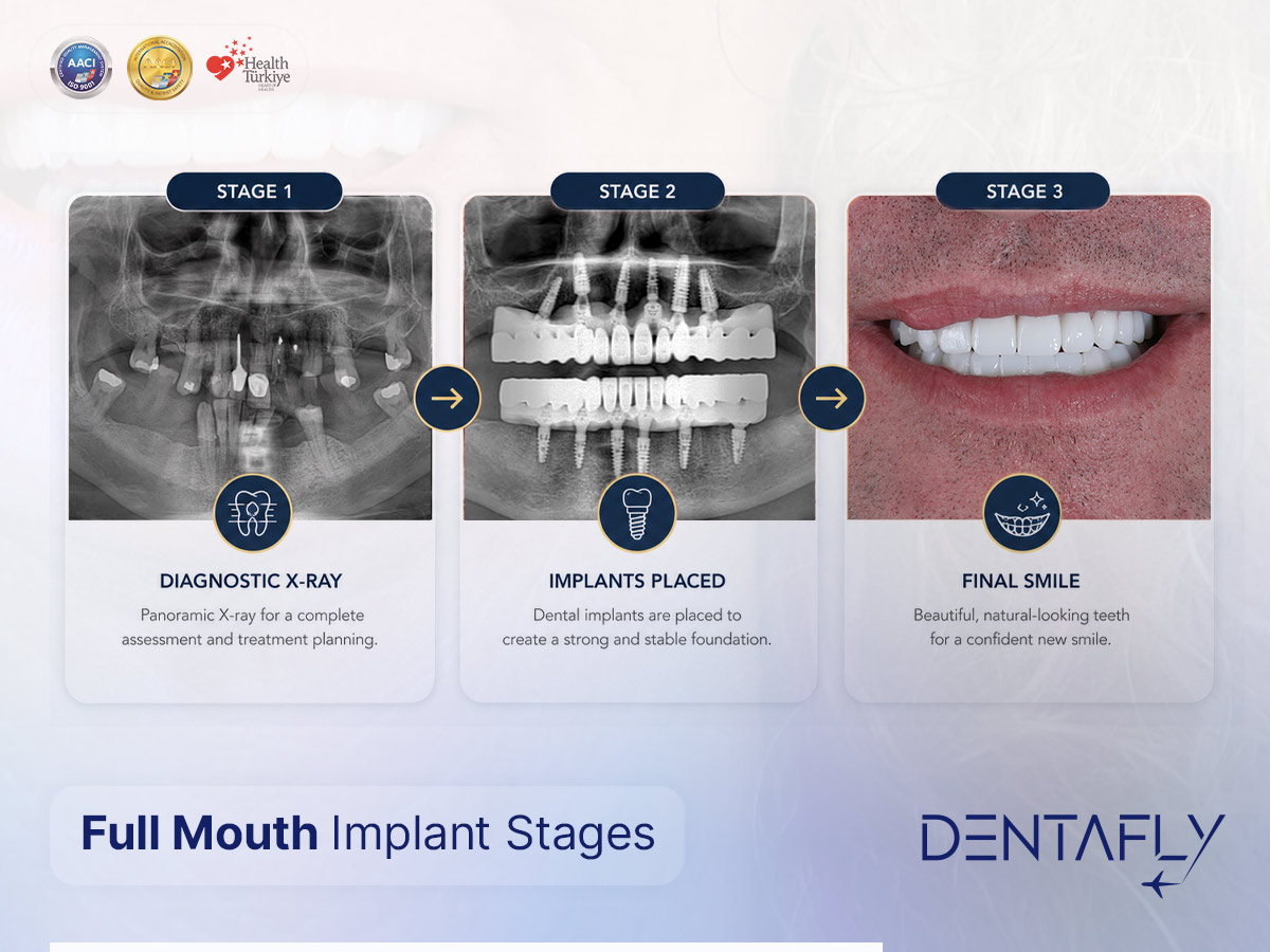 Full mouth implant treatment stages at DentaFly Full mouth dental implant stages: diagnostic X-ray, implants placed, final smile