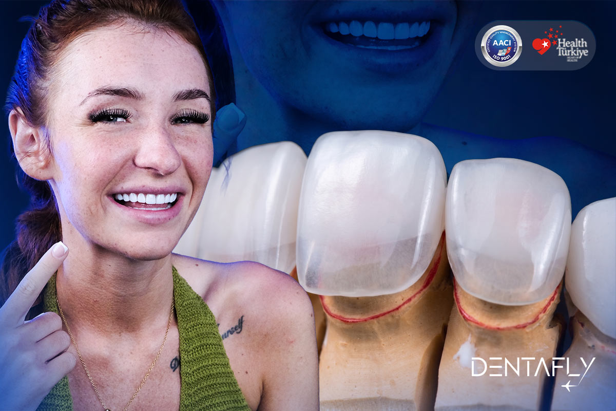 Before and after comparison of a patient who received Lumineers in Turkey